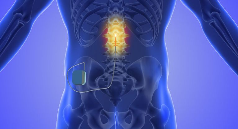 Rückenmarksstimulation